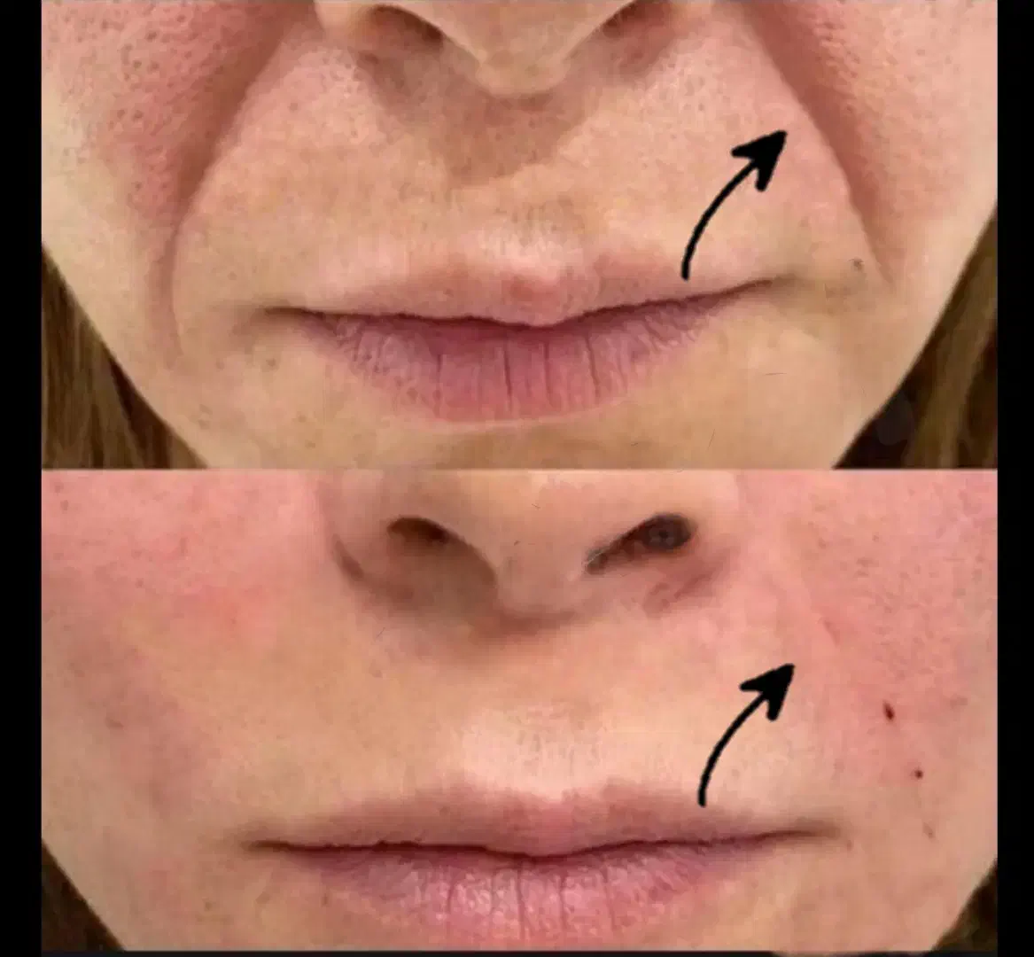 لیپوساکشن چربی جراحی بلفارو لیفت نخ ژل|خدمات آرایشگری و زیبایی|کوهدشت, |دیوار