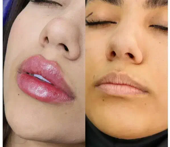 تزریق ژل و بوتاکس|خدمات آرایشگری و زیبایی|اهواز, نادری|دیوار