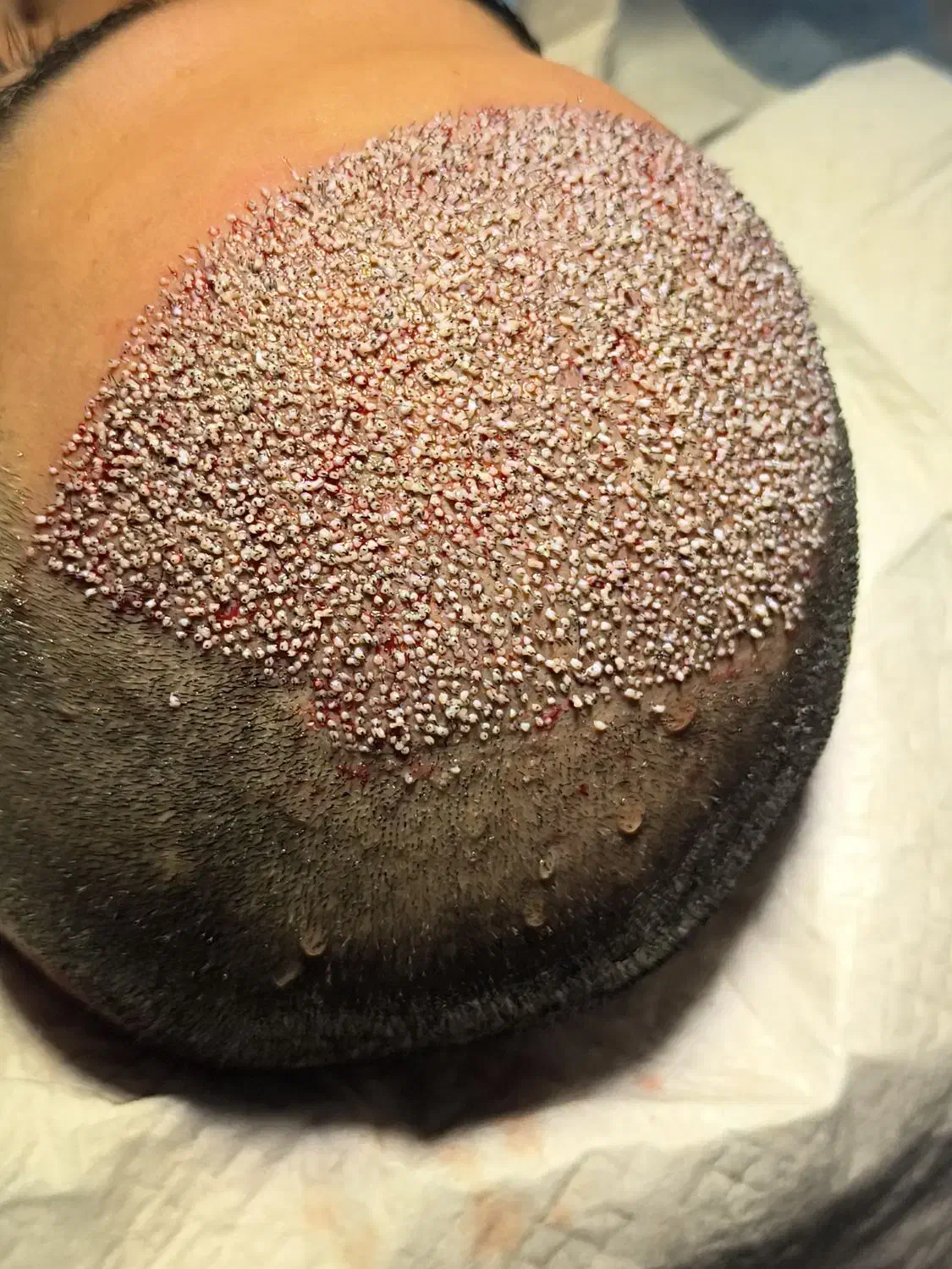 کاشت مو،ابرو و ریش|خدمات آرایشگری و زیبایی|پاوه, |دیوار