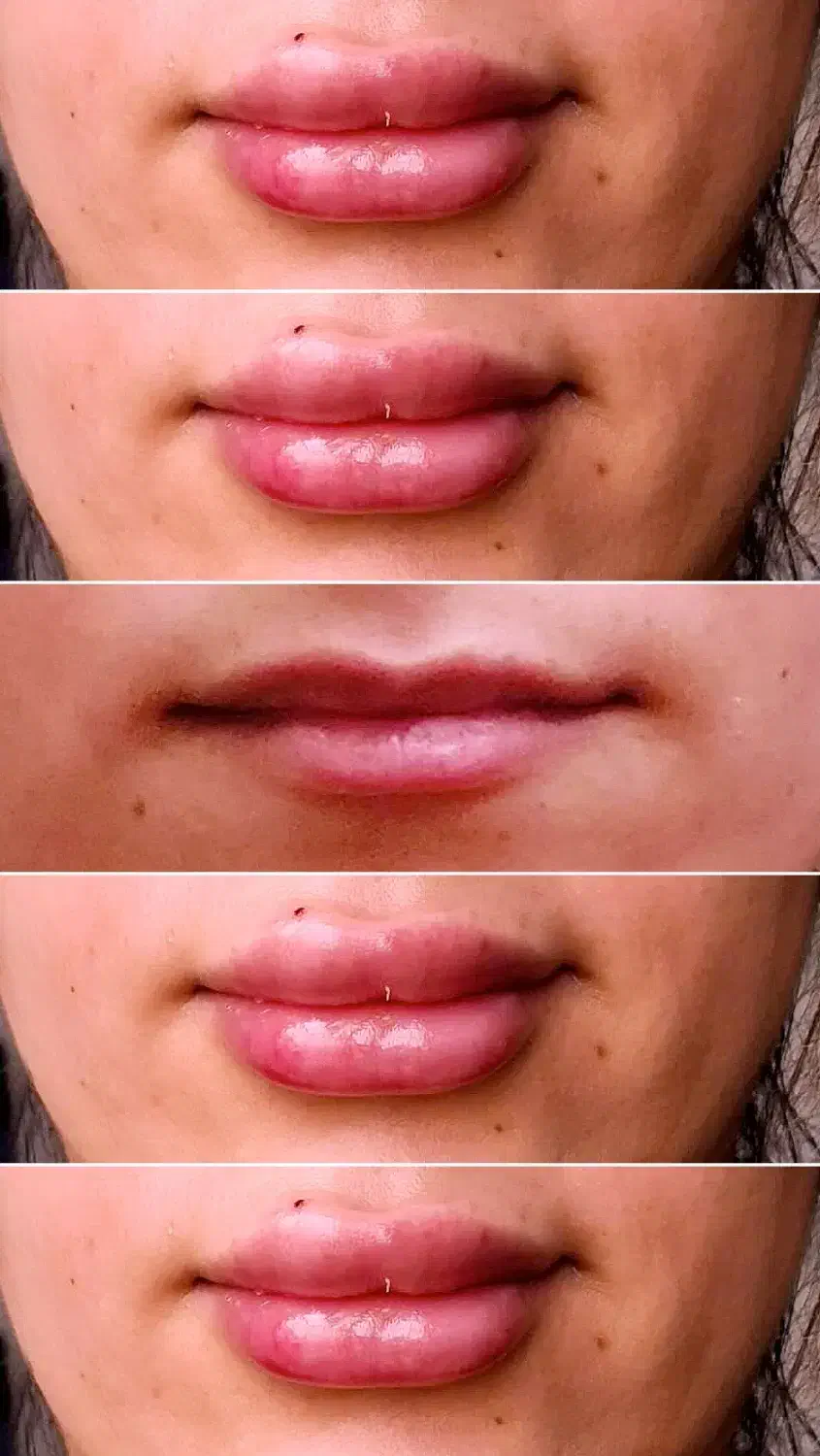 ژل و بوتاکس|خدمات آرایشگری و زیبایی|تهران, تهرانسر شمالی|دیوار