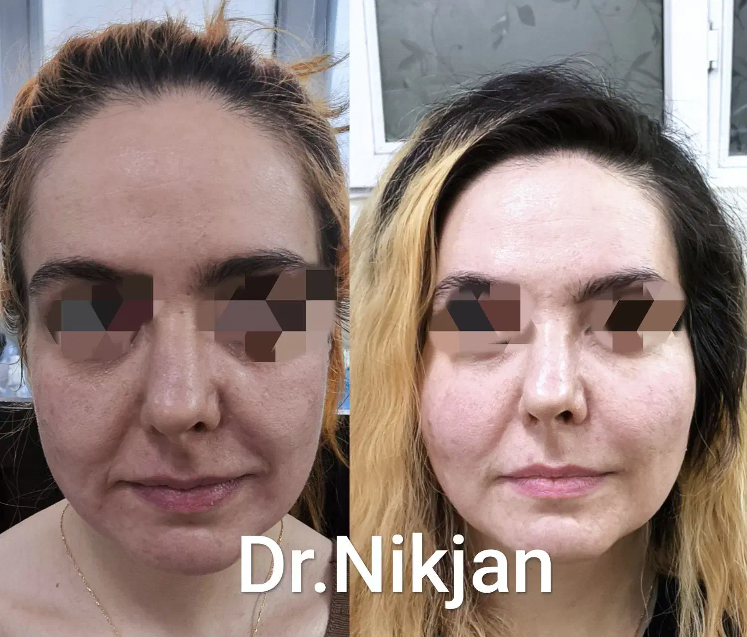 فیلر/بوتاکس/لب روسی/جوانساز/مزوژل مطب دکتر نیک جان|خدمات آرایشگری و زیبایی|رشت, گلسار|دیوار