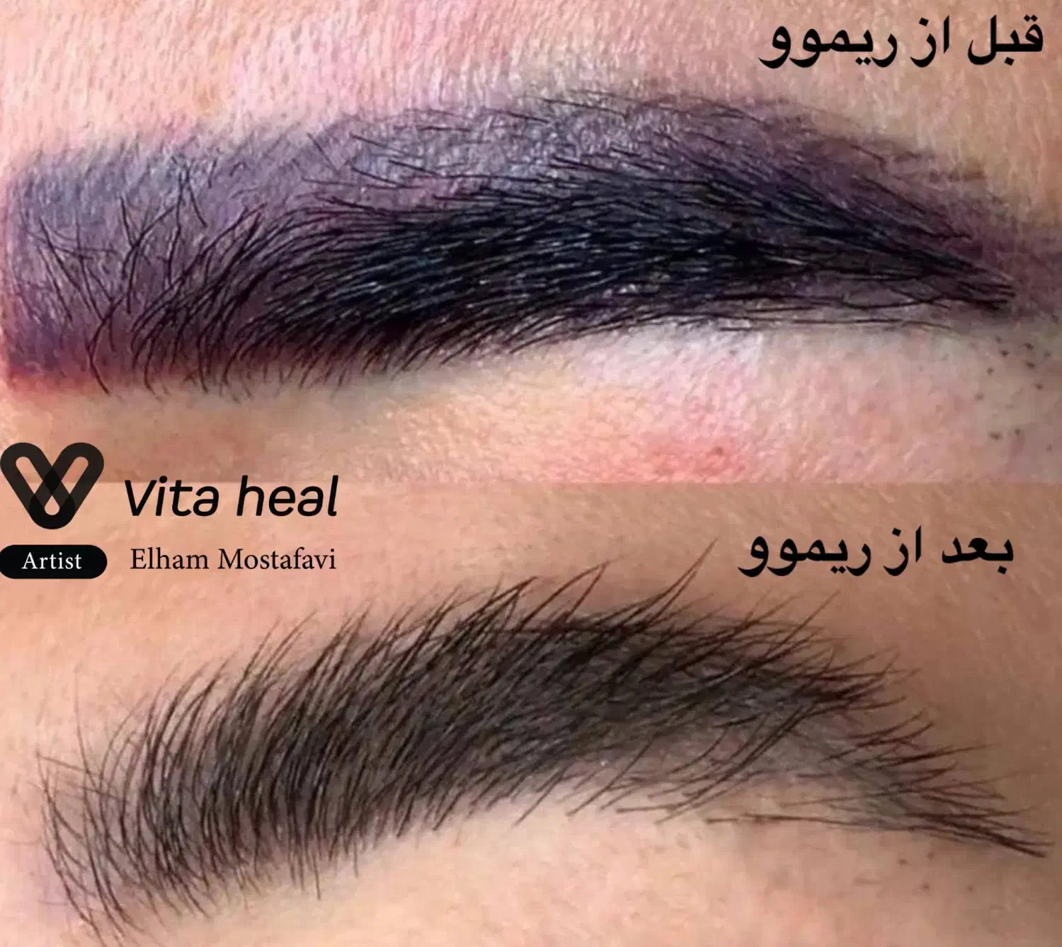 تخفیف ۵۰ درصدی ریموو تخصصی تاتو|خدمات آرایشگری و زیبایی|شیراز, تندگویان|دیوار