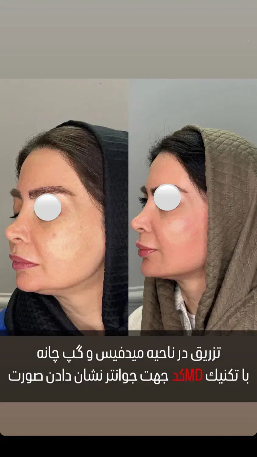بوتاکس چشم گربه ای ۵۹۹ژللب روسی۱/۲۰۰مادلینگ۶میلیون|خدمات آرایشگری و زیبایی|قم, حاج زینل|دیوار