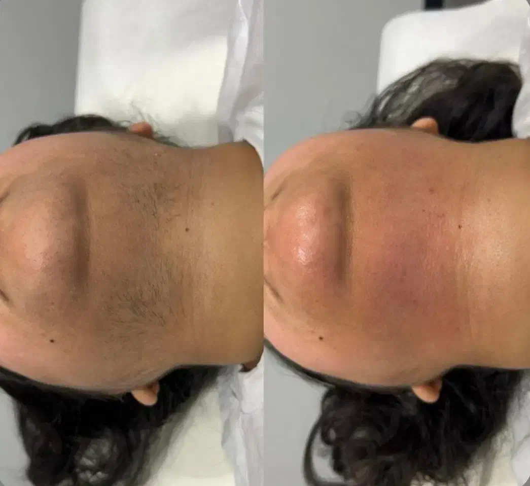 لیزر کل بدن (فول بادی)فقط۴۹۰تومن|خدمات آرایشگری و زیبایی|گنبد کاووس, |دیوار