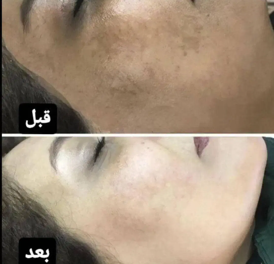 درمان بیماری پوستی|آرایشی، بهداشتی، درمانی|بوشهر, |دیوار