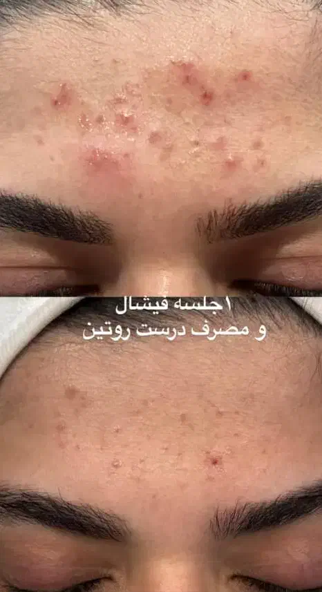 پاکسازی فیشال و آبرسانی درمان لک و جوش|خدمات آرایشگری و زیبایی|زابل, |دیوار