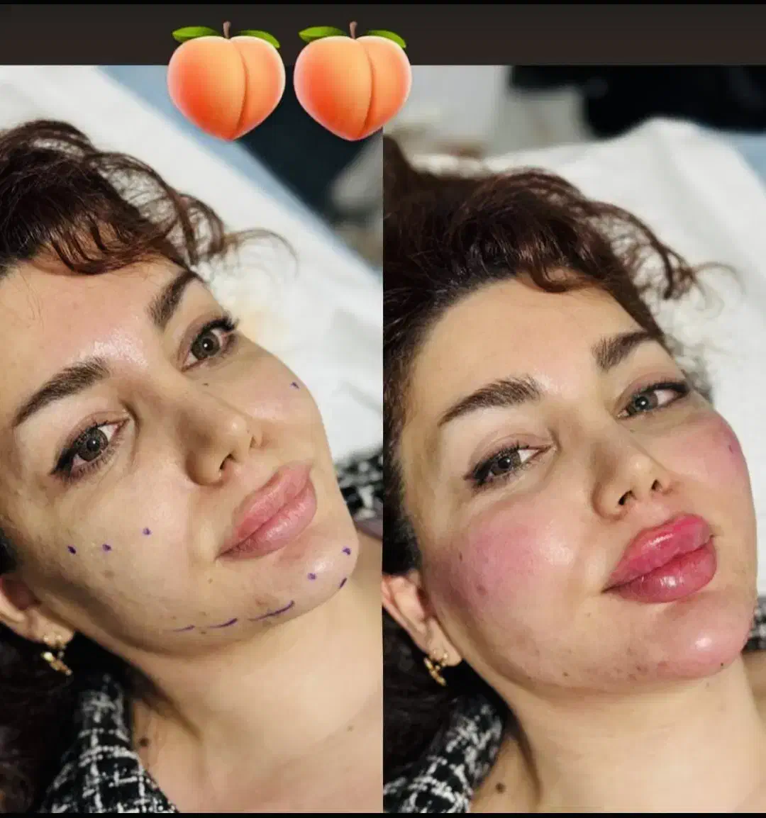 تخفیف جشنواره تزریق ژل و فیلر لب و فول فیس در مطب|خدمات آرایشگری و زیبایی|اصفهان, ملکشهر|دیوار