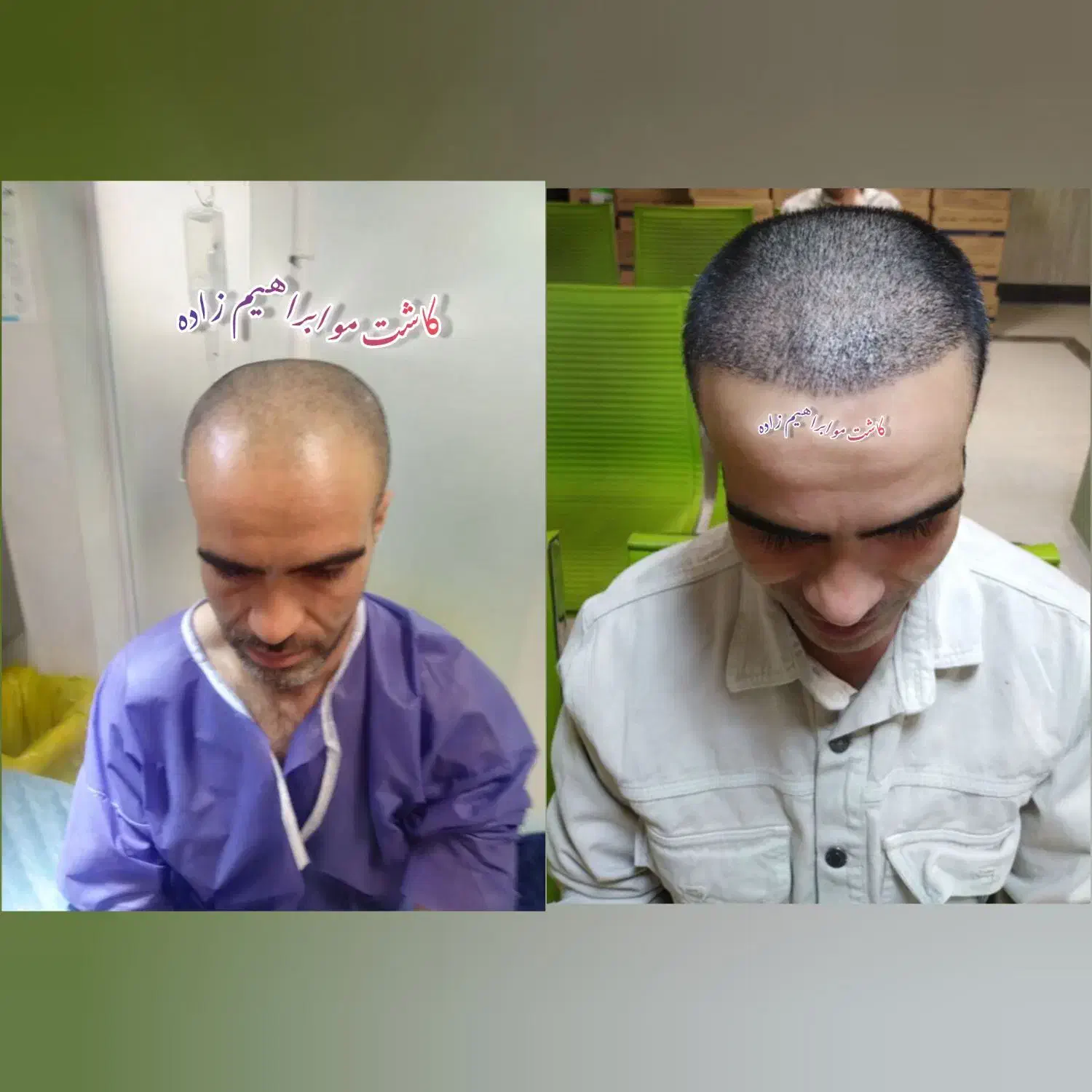 کاشت مو باتخفیف ویژه، یا(اقساطی)|خدمات آرایشگری و زیبایی|شیراز, معالی‌آباد|دیوار