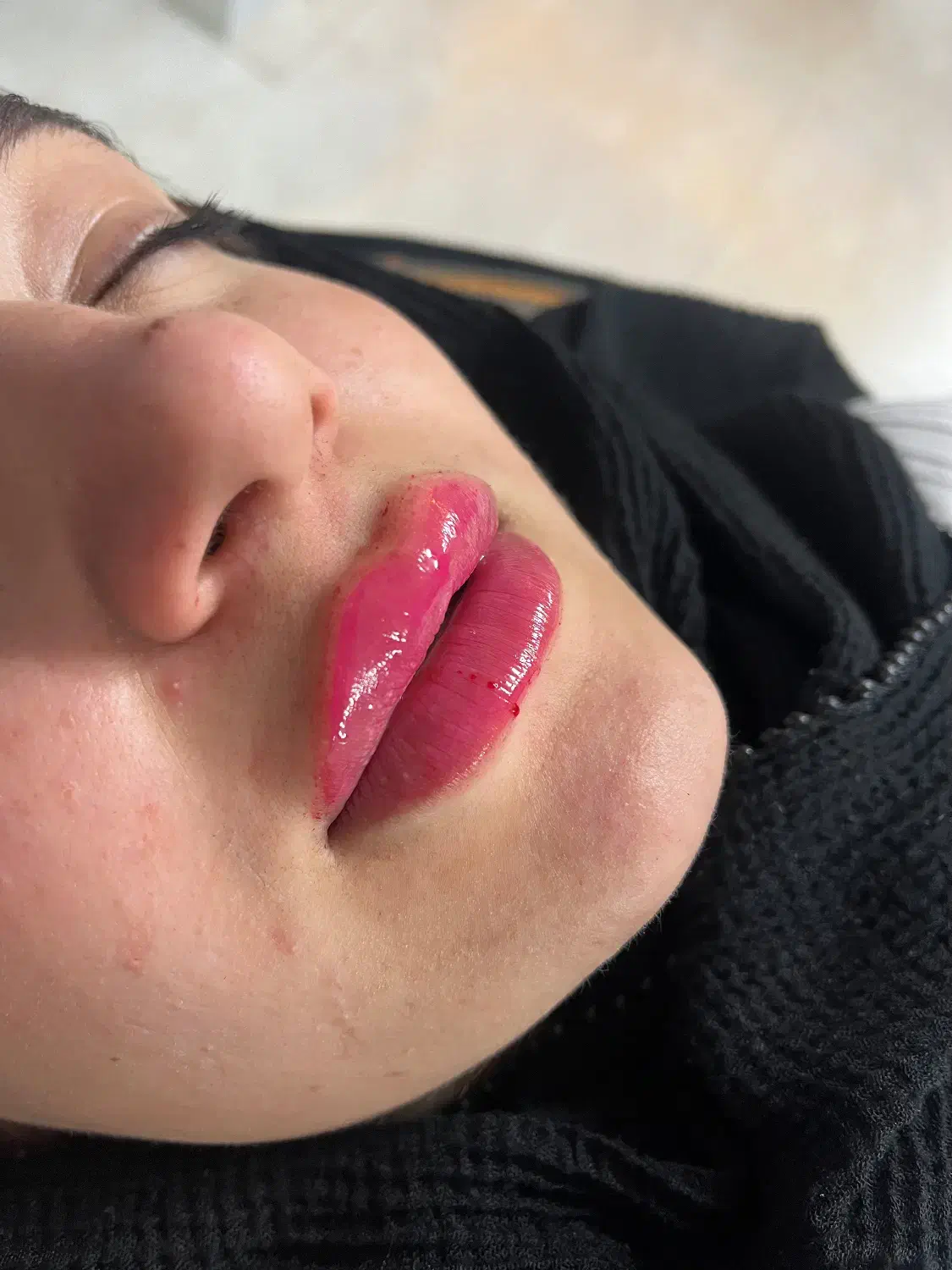 تزریق ژل و بوتاکس|خدمات آرایشگری و زیبایی|بابل, |دیوار