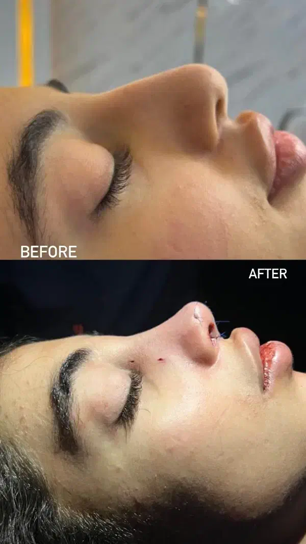 آف ویژه زیبایی بینی|خدمات آرایشگری و زیبایی|بهبهان, |دیوار