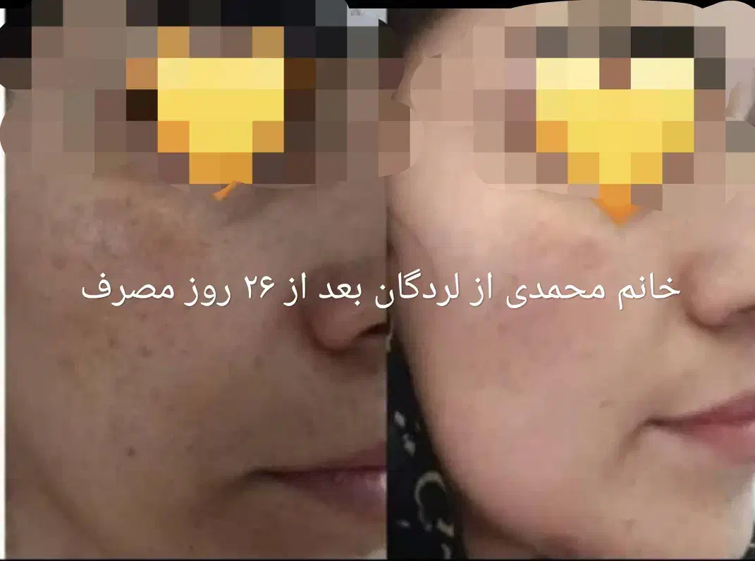 کرم معجزه اصل ضد لک و جوش سفید شدن پوست ضمانتی|آرایشی، بهداشتی، درمانی|لردگان, |دیوار