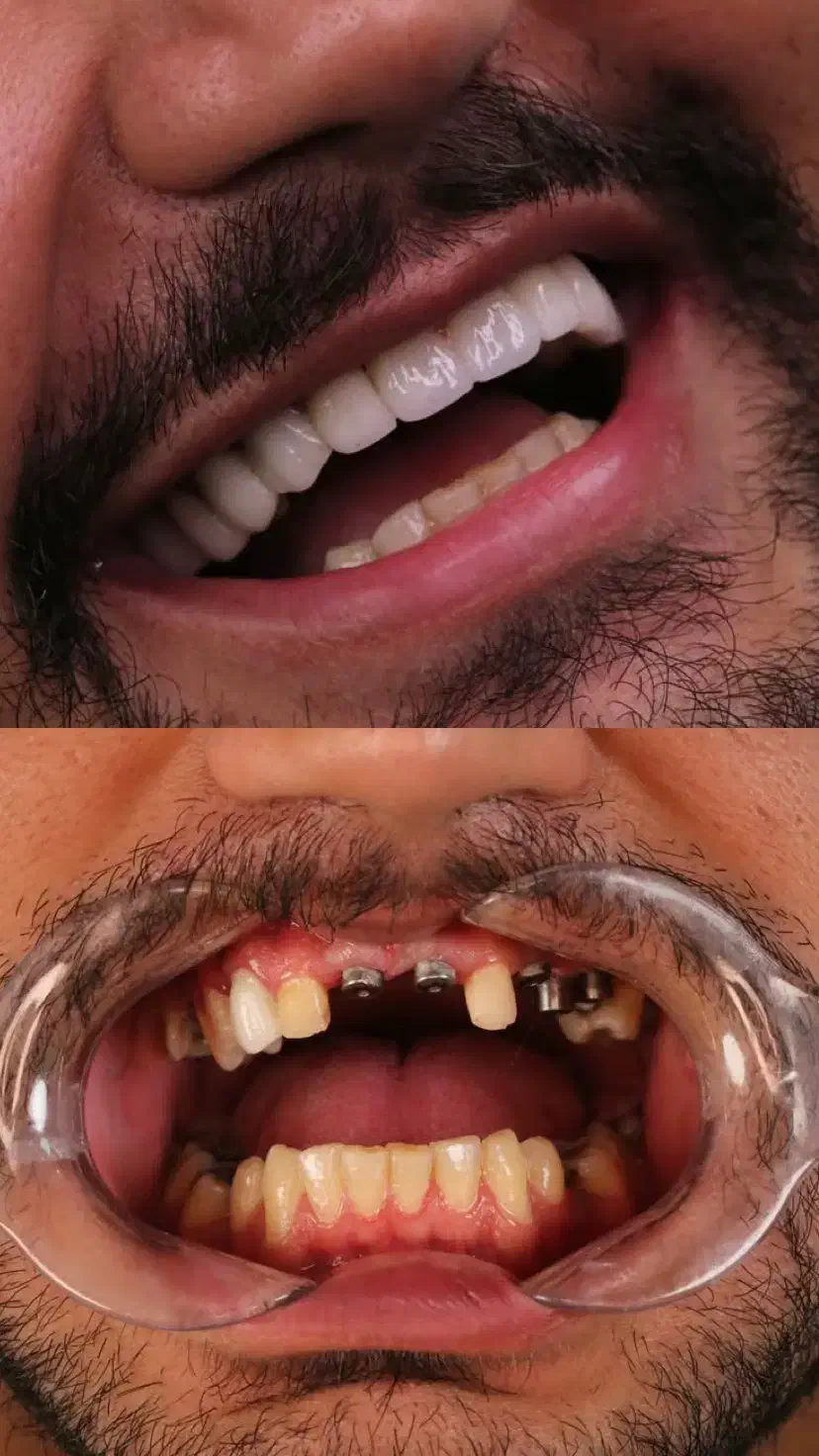 دندانپزشکی،ایمپلنت،اوردنچر با اقساط دو ساله|خدمات آرایشگری و زیبایی|اهر, |دیوار