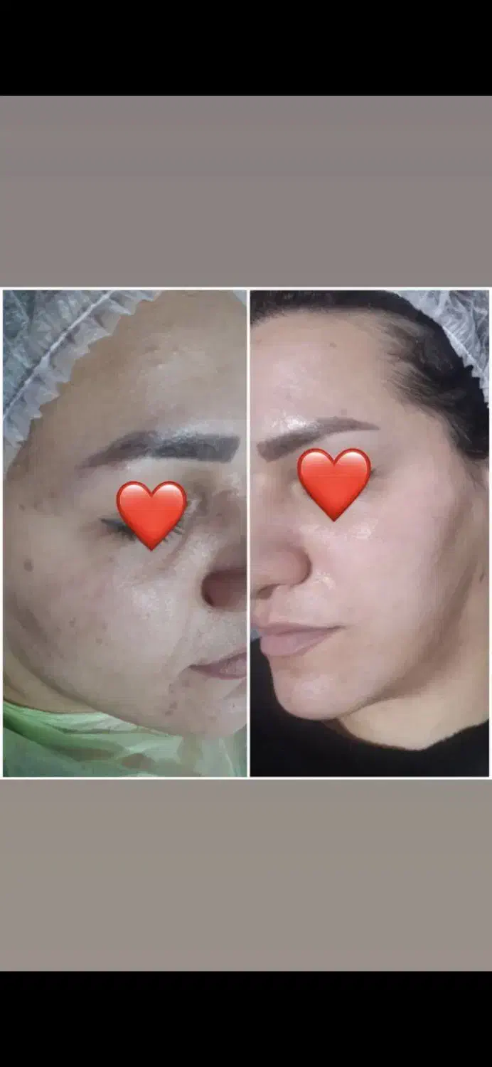 فیشیال و پاک سازی درمانی ۵۰۰ تومان گلستان،سعدی|خدمات آرایشگری و زیبایی|اهواز, کوی سعدی|دیوار