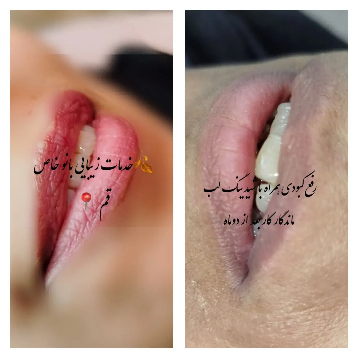 شیدینگ لب حرفه ای|خدمات آرایشگری و زیبایی|قم, طلاب غیر ایرانی|دیوار