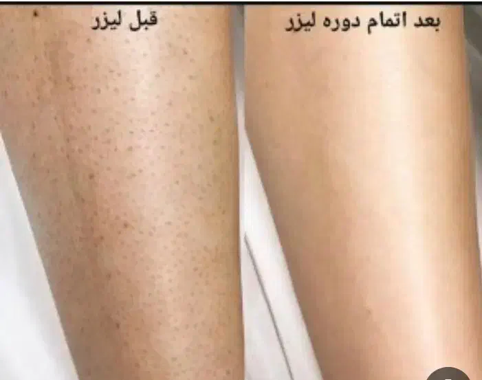 لیزر موژان|خدمات آرایشگری و زیبایی|تهران, اتابک|دیوار