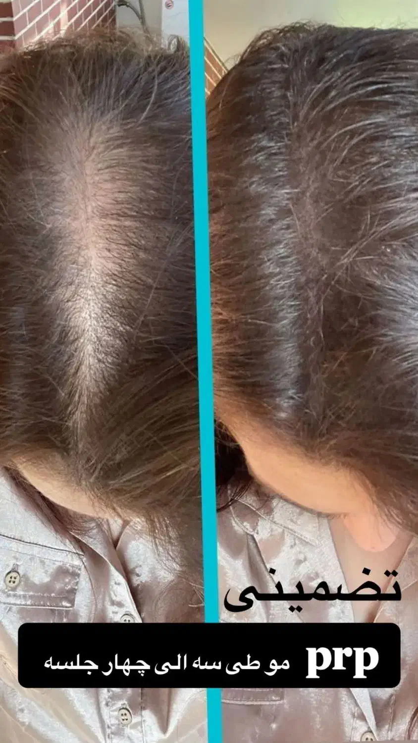 تخفیفات فوق العاده در کلینیک پوست ومو|خدمات آرایشگری و زیبایی|اندیشه, اندیشه فاز ۶|دیوار