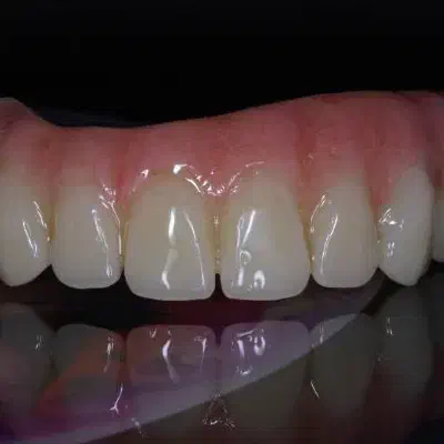 روکش تمام سرامیک ودندان مصنوعی|آرایشی، بهداشتی، درمانی|اندیمشک, |دیوار