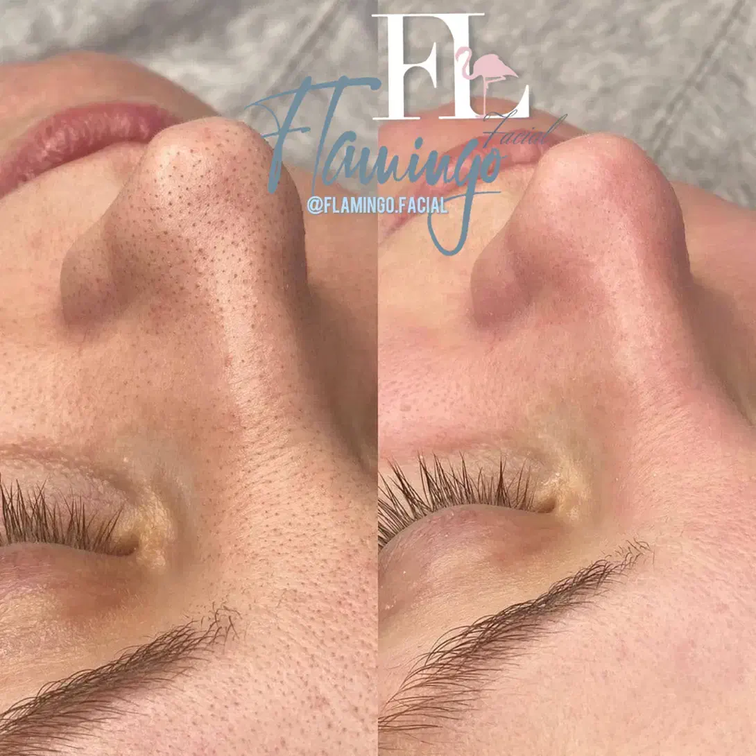 فیشالدرمطب/درمانجوشوخشکی آراف|خدمات آرایشگری و زیبایی|قم, دورشهر|دیوار