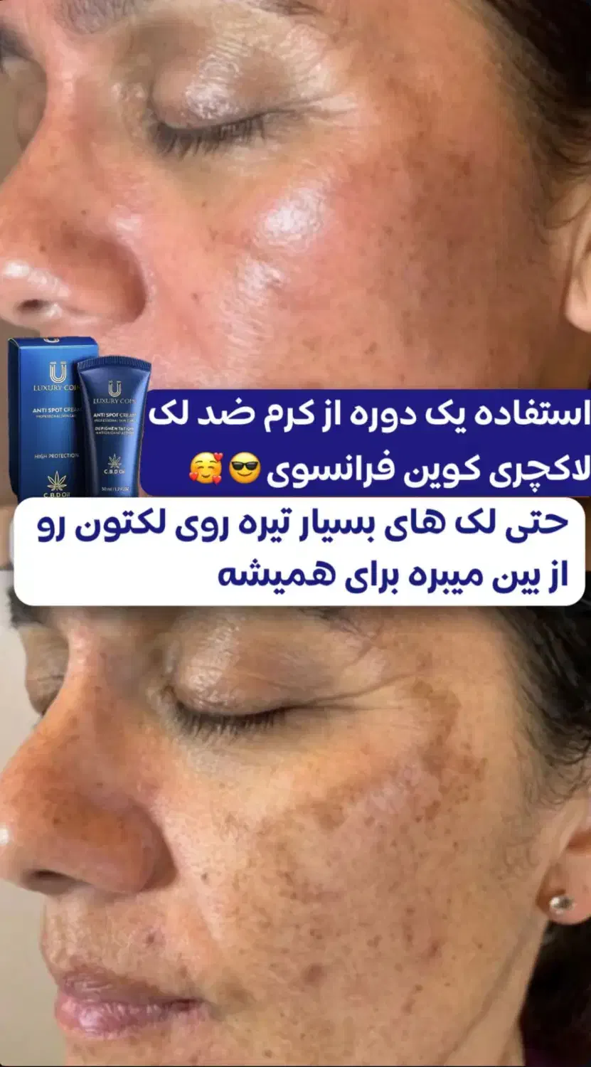 کرم ضدلک لاکچری کوین اصل|آرایشی، بهداشتی، درمانی|شیراز, فرهنگ شهر|دیوار