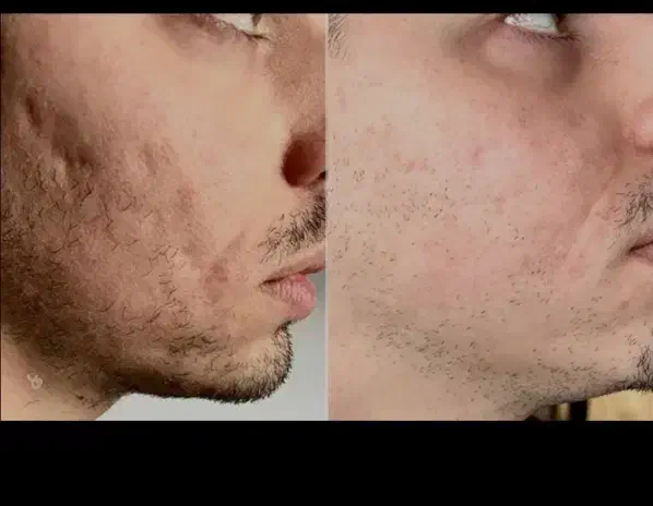 درمان همیشگی تورفتگی پوست/ جای جوش/اسکار/اگزوزوم|خدمات آرایشگری و زیبایی|اصفهان, سروستان|دیوار