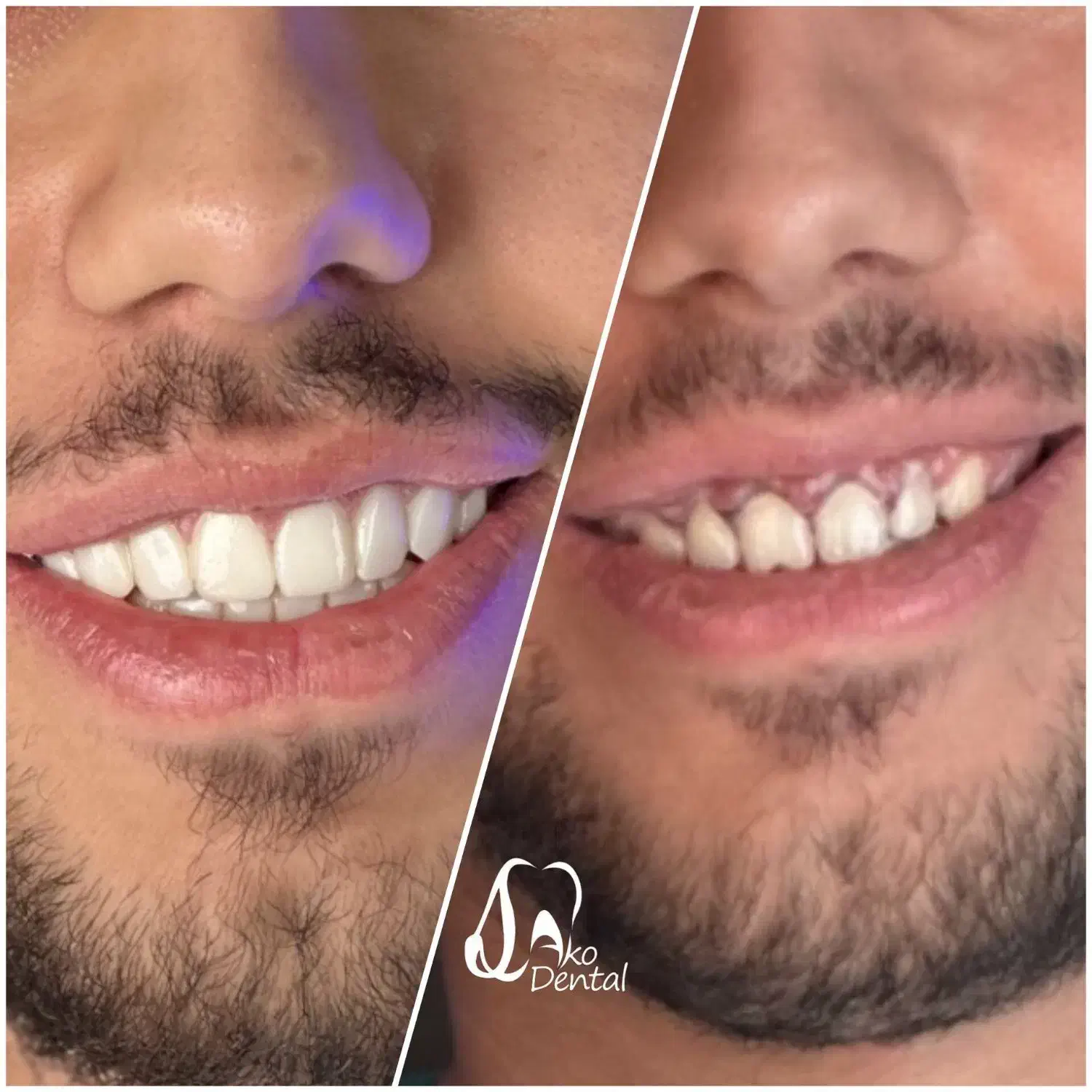 ایمپلنت و زیبایی دندان اقساط ۱۲ ماهه اکو دنتال|خدمات آرایشگری و زیبایی|تهران, خانی آباد نو شمالی|دیوار