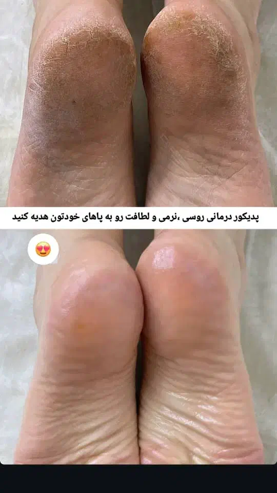 اسپا درمانی کف پا|خدمات آرایشگری و زیبایی|دیلم, |دیوار