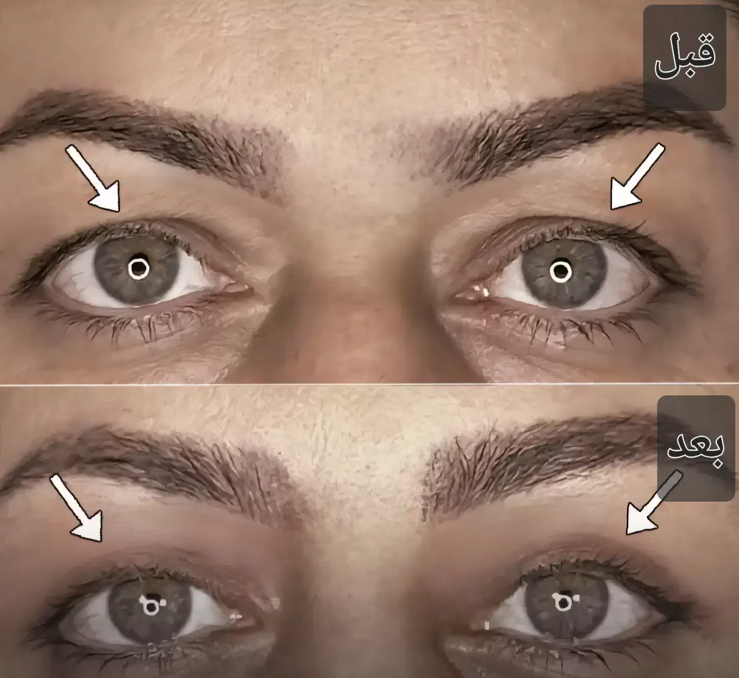 جشنواره تخفیف بلفاروپلاستی(جراحی پلک)|خدمات آرایشگری و زیبایی|شاهینشهر, فردوسی|دیوار