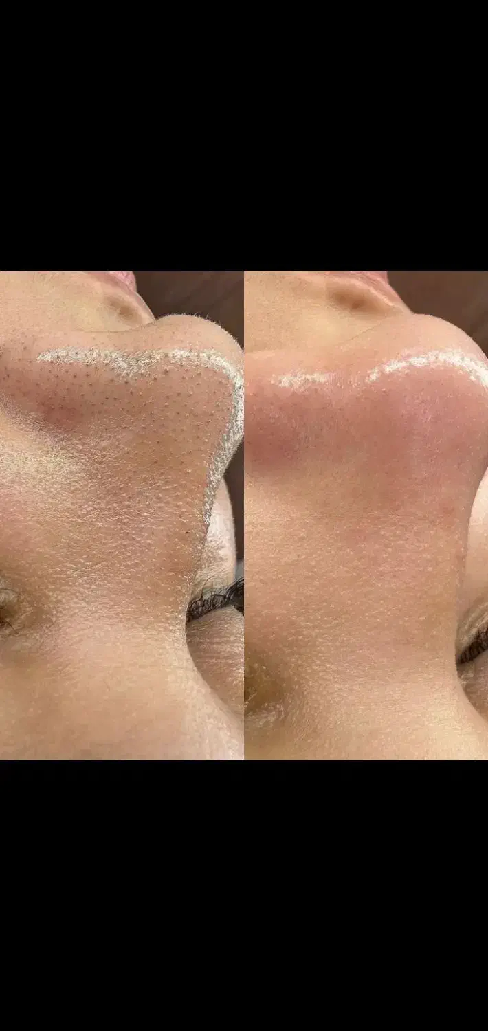 پاکسازی تخصصی  پوست|خدمات آرایشگری و زیبایی|دهدشت, |دیوار