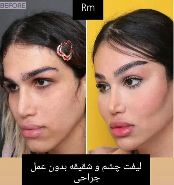 لیفت فول فیس صورت لیفت چشم گربه ای بدون عمل جراحی|خدمات آرایشگری و زیبایی|ری, دیلمان|دیوار