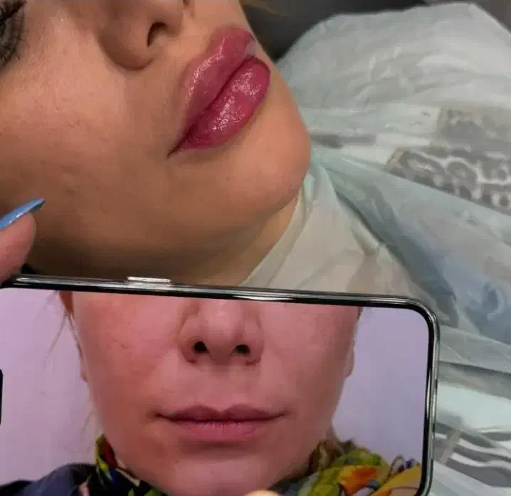 تزریق بوتاکس فیلر انزیم prp مزوتراپی جوانسازی|خدمات آرایشگری و زیبایی|کرمانشاه, |دیوار