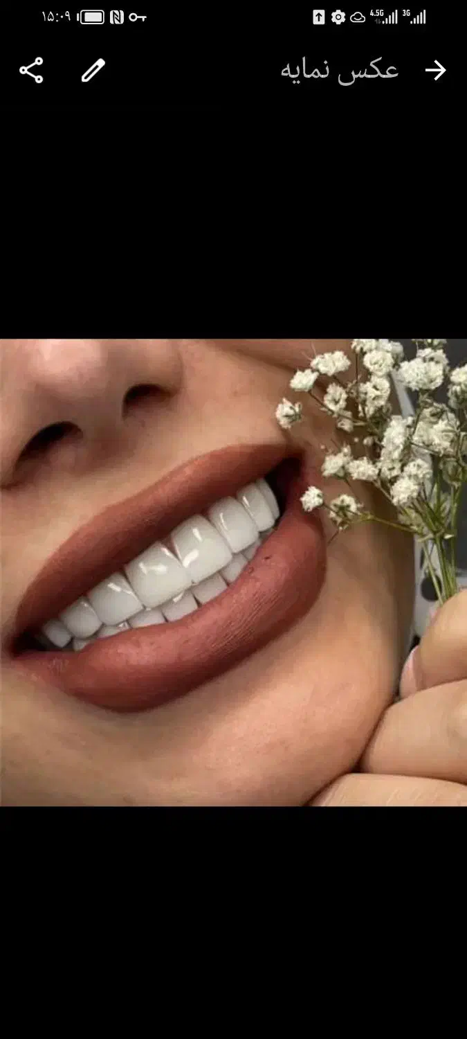ایمپلنت دندان فقط از 6900 قسطی 6 تا 24 ماه|خدمات آرایشگری و زیبایی|تهران, میرداماد|دیوار