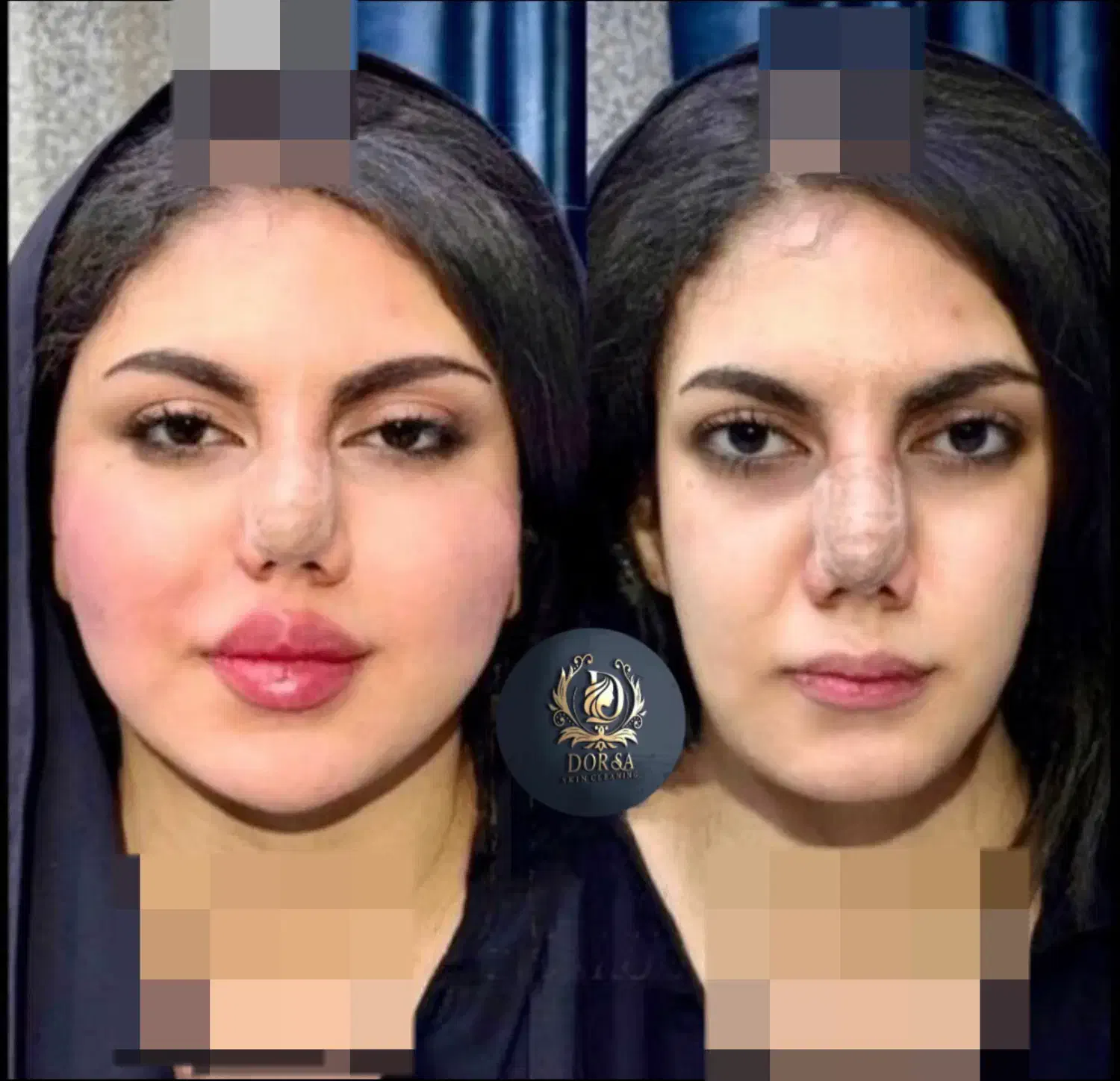 تزریق تخصصی ژل ومادلینگ خلیجی واروپایی وبوتاکس|خدمات آرایشگری و زیبایی|کرمانشاه, |دیوار