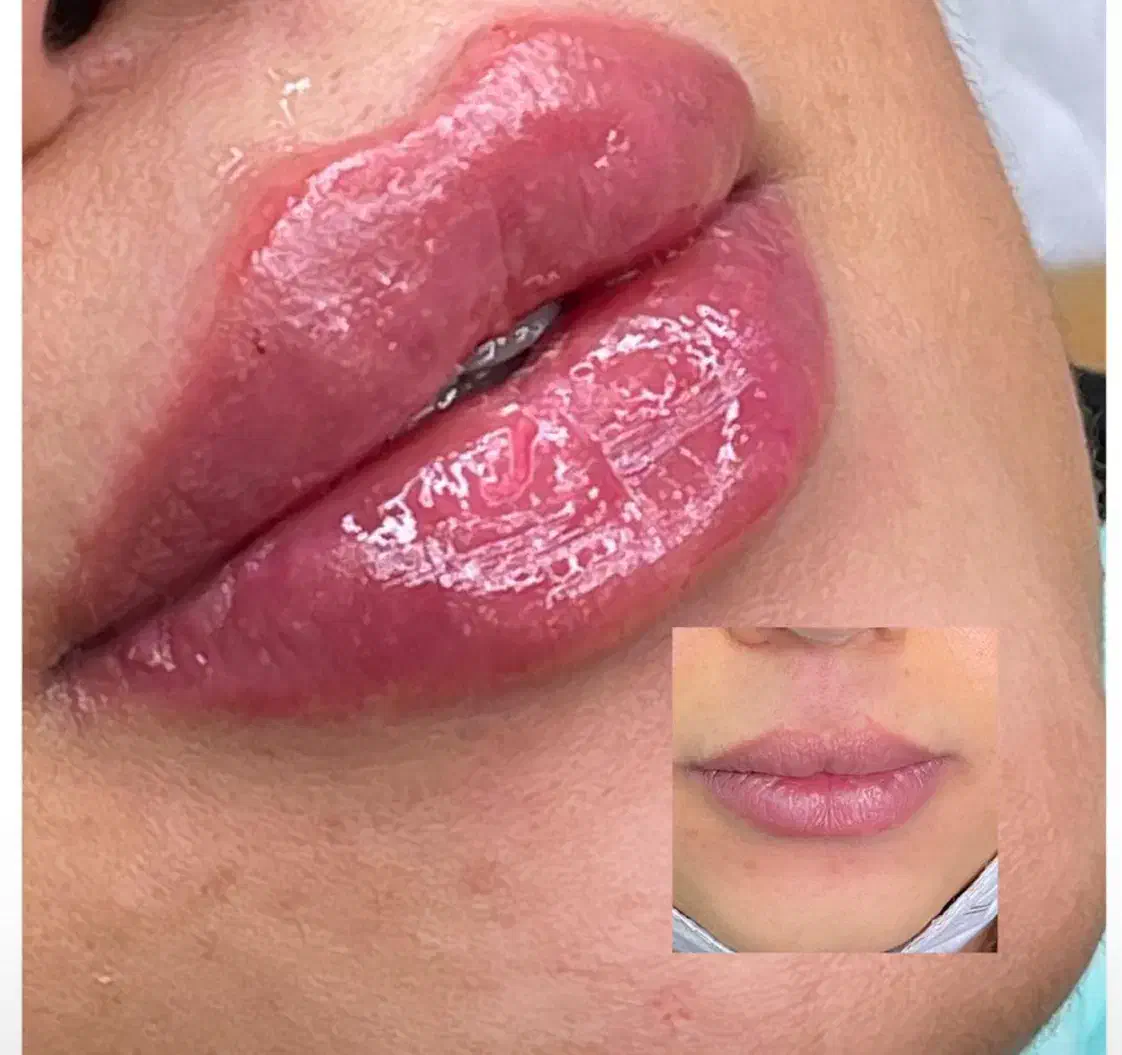 تزریق ژل سی سی 600|خدمات آرایشگری و زیبایی|پیشوا, |دیوار