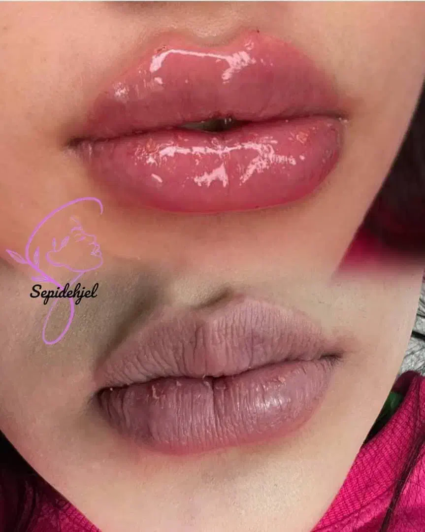 ژل و بوتاکس مزو و انزیم، سیار هستم...|خدمات آرایشگری و زیبایی|قرچک, شهرک طلائیه|دیوار