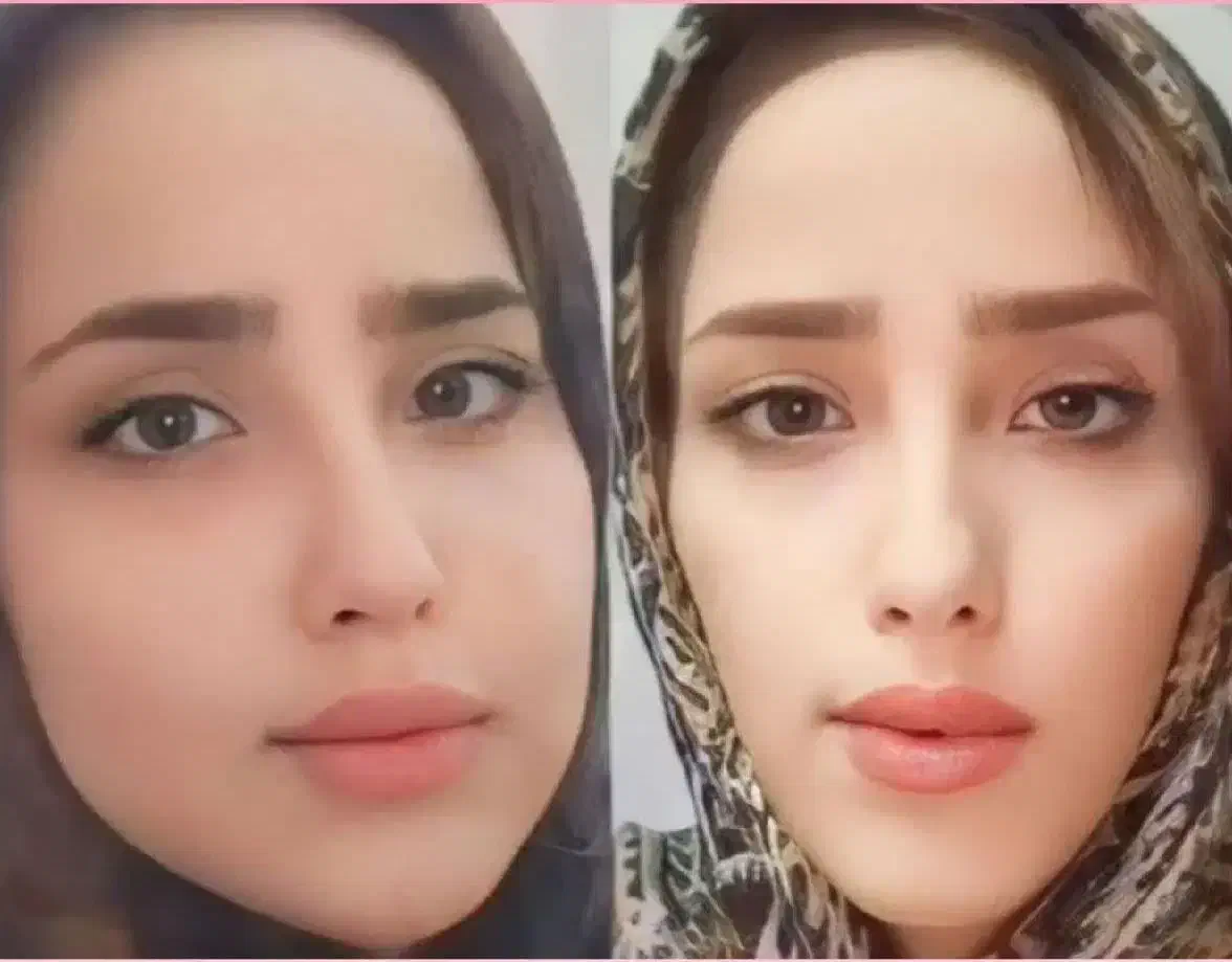 چاقی و طراوت وجوانی صورتتان را برمیگردانیم|آرایشی، بهداشتی، درمانی|سیرجان, |دیوار