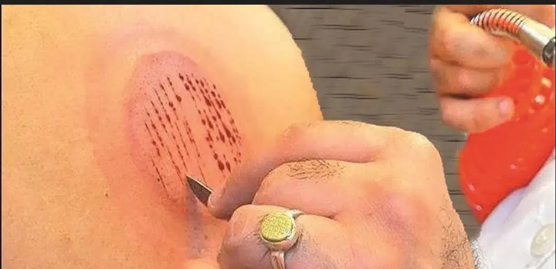 آموزش حجامت|خدمات آموزشی|قوچان, |دیوار