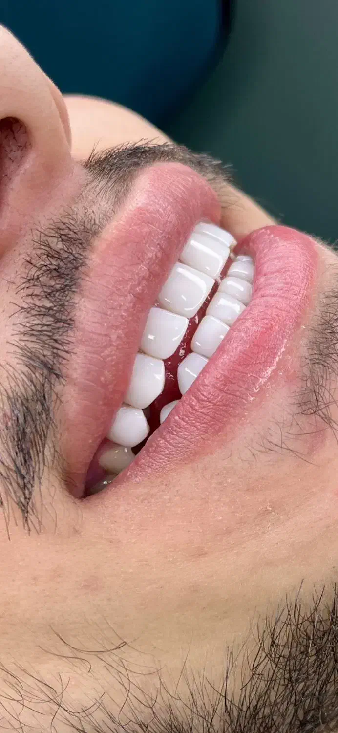 مدل کامپوزیت دندان|خدمات آرایشگری و زیبایی|تهران, هاشمی|دیوار