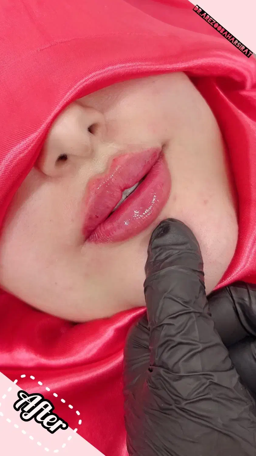 جشنواره پاییزی تخفیف ژل و بوتاکس توسط پزشک|خدمات آرایشگری و زیبایی|یاسوج, |دیوار