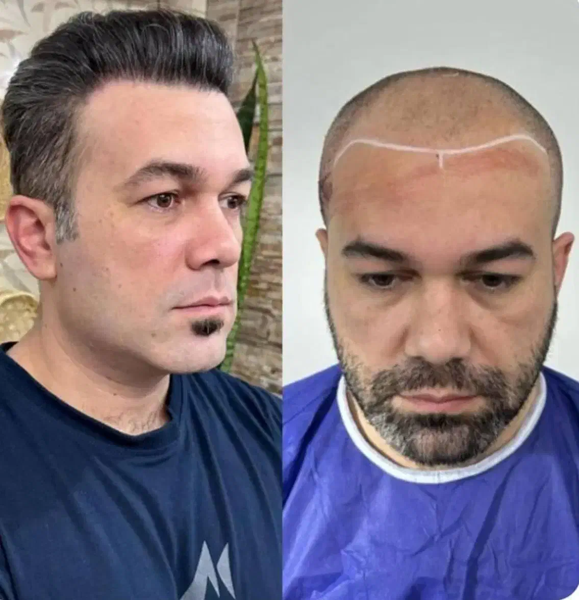 کاشت مو/کاشتمو/کاشت ریش یک مرحله ای|خدمات آرایشگری و زیبایی|نجفآباد, باغ ملی|دیوار