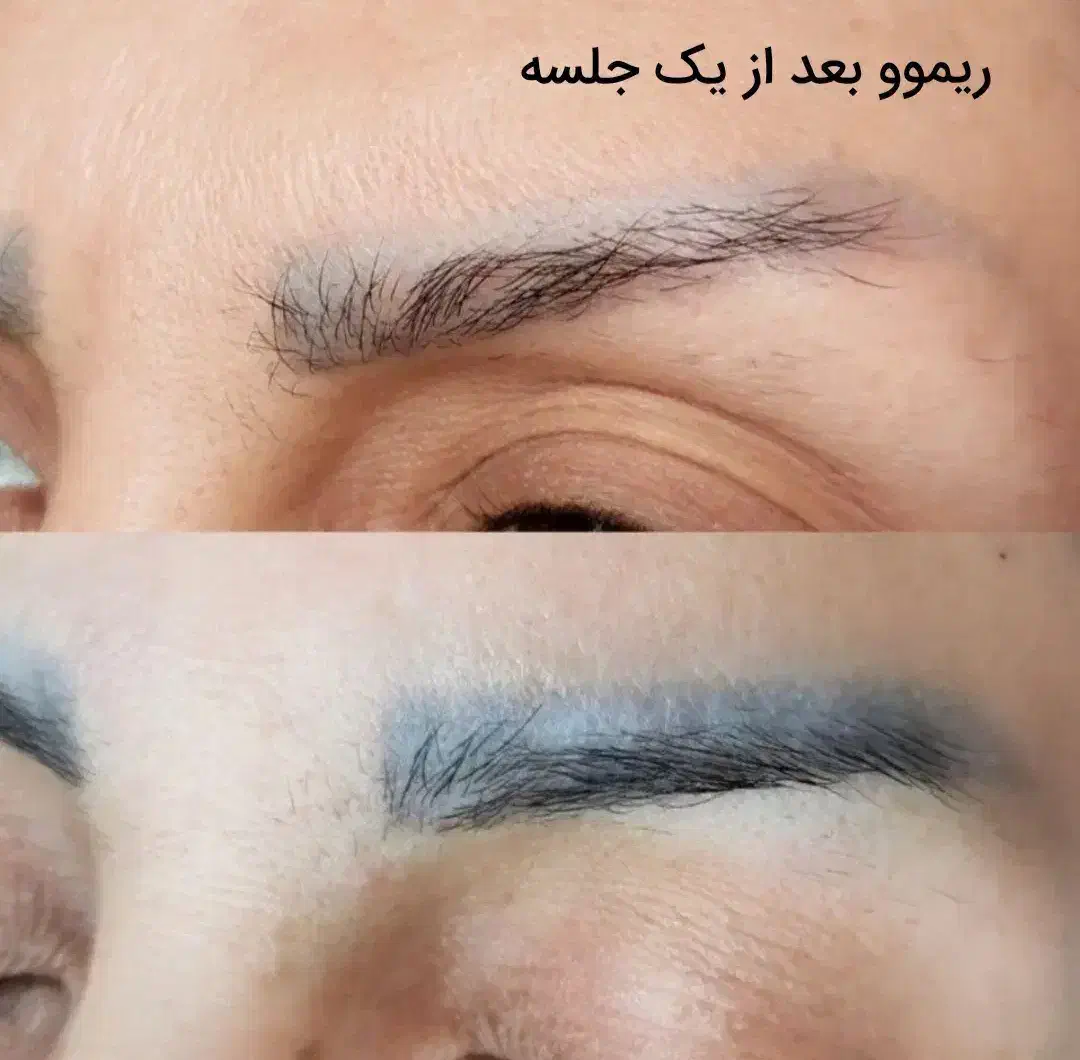 ریموو درمانی تتو های بدرنگ قدیمی|خدمات آرایشگری و زیبایی|الشتر, |دیوار