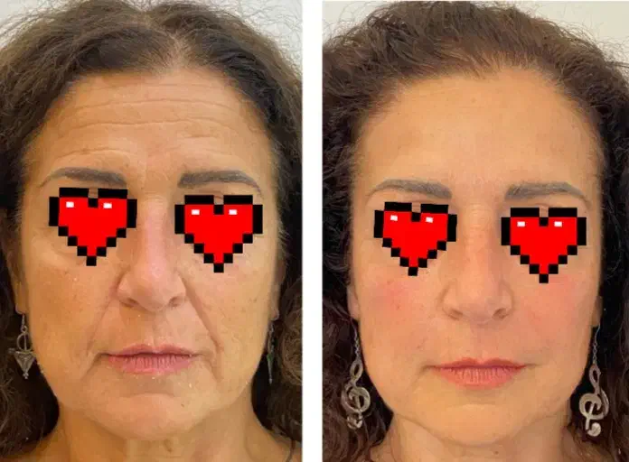 تخفیف ویژه بوتاکس، ژل، پی آر پی، رفع کک و مک|خدمات آرایشگری و زیبایی|بوکان, |دیوار