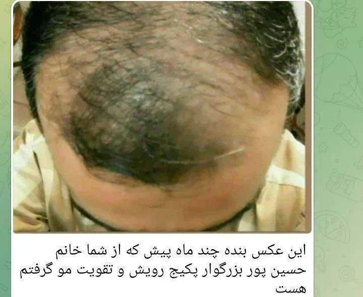 رویش مجدد مو|آرایشی، بهداشتی، درمانی|کوهدشت, |دیوار