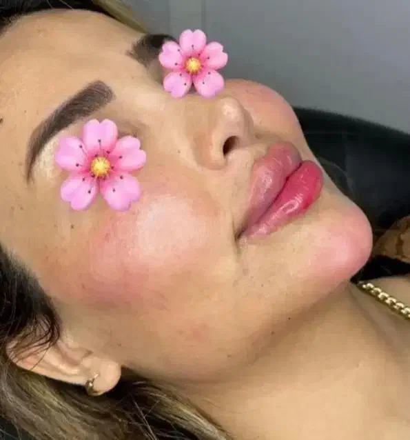 تزریق فیلر|خدمات آرایشگری و زیبایی|الشتر, |دیوار