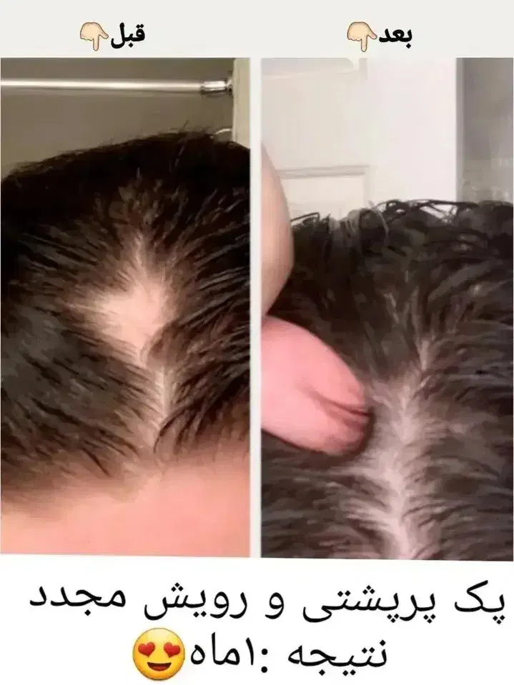 ریزش مو.  و مشکلات پوست مو.|آرایشی، بهداشتی، درمانی|کلاله, |دیوار
