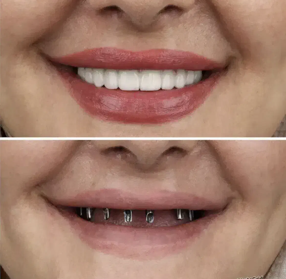 جشنواره تخفیف ایمپلنت در تبریز،با روکش فقط ۱۶تومن|خدمات آرایشگری و زیبایی|خوی, |دیوار