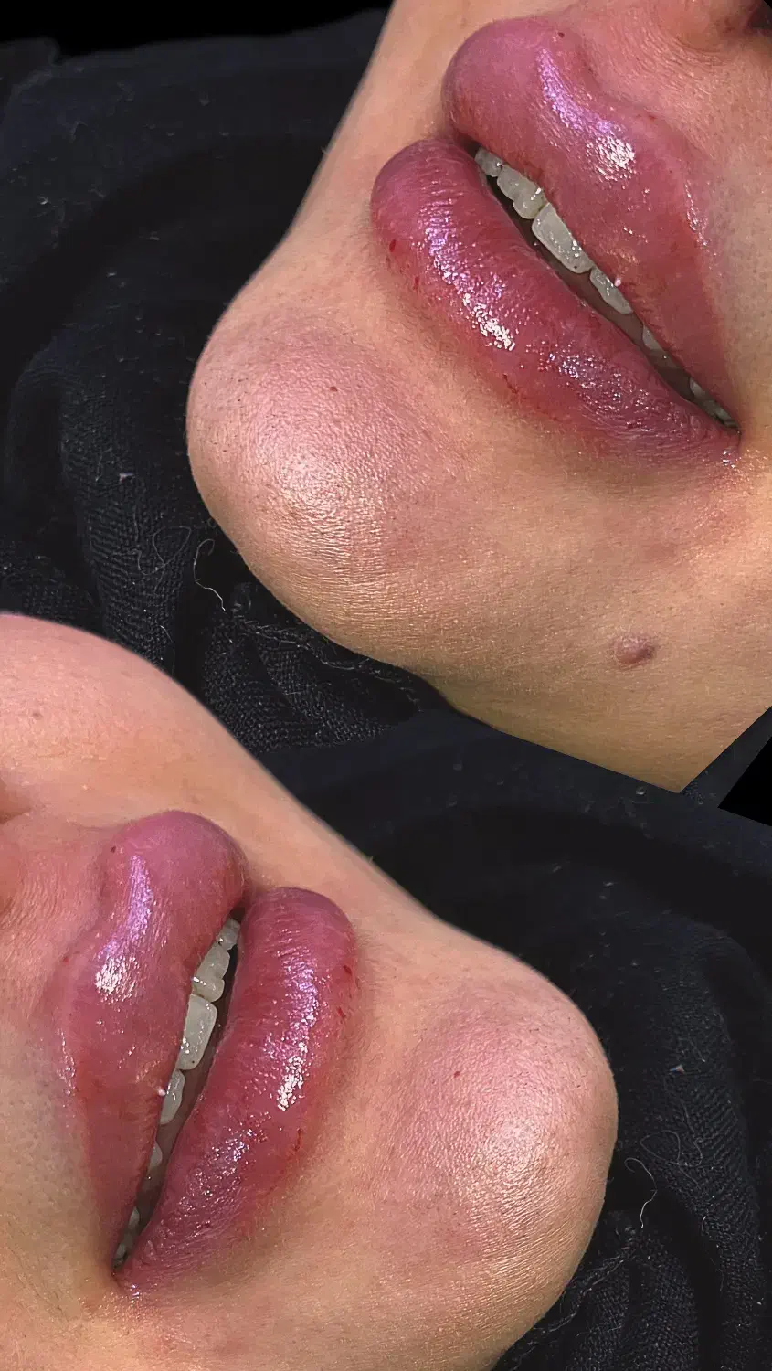 ژل و بوتاکس|خدمات آرایشگری و زیبایی|تهران, تهرانسر شمالی|دیوار