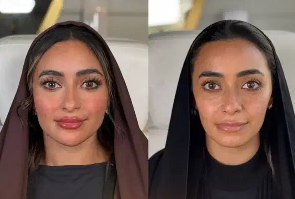 جوان کردن صورت در یک جلسه هایفو تراپی با ۸۵۰هزار ت|خدمات آرایشگری و زیبایی|اصفهان, احمدآباد|دیوار