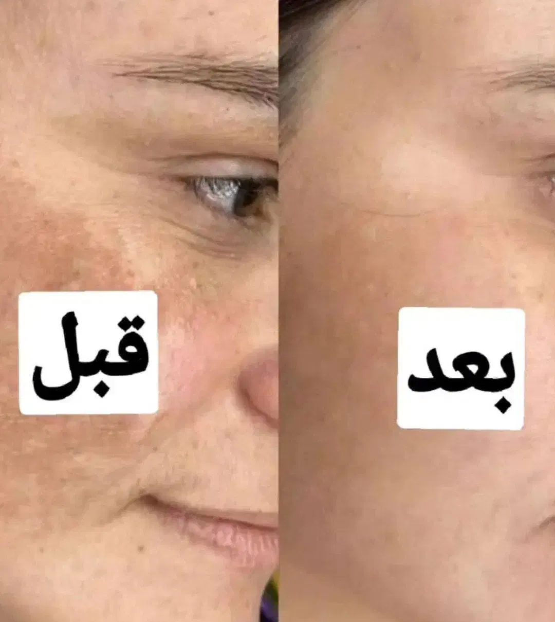 توجه توجه برداشتن خال،کک به صورت کاملا تضمینی|خدمات آرایشگری و زیبایی|تاکستان, |دیوار