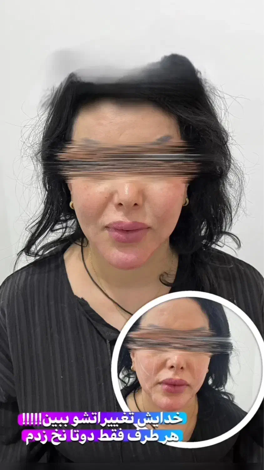 مرکزتخصصی لیفت بانخ و کانتورینگ صورت|خدمات آرایشگری و زیبایی|کرمانشاه, |دیوار