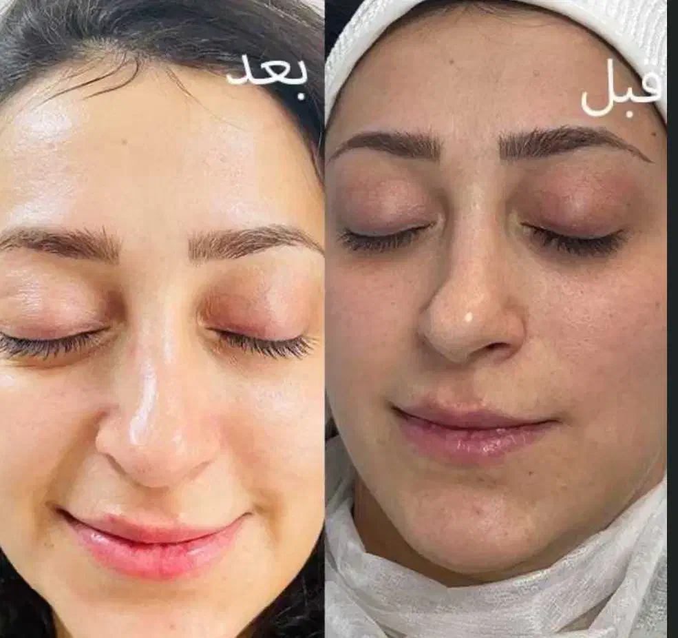 فشیال و پاکسازی پوست|خدمات آرایشگری و زیبایی|فیروزآباد (فارس), |دیوار